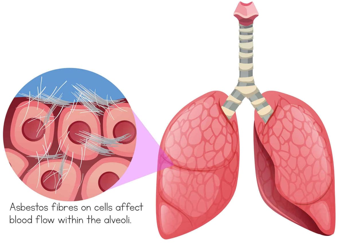 asbestos-fibres-in-lung